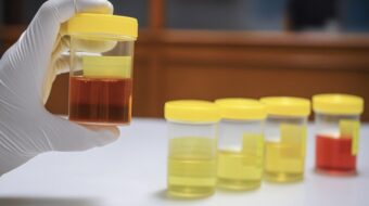 Was die Farbe Ihres Urins verrät – von klar bis dunkelbraun. Ursachen, Risiken, Tipps und wann Sie in der Schweiz ärztliche Hilfe suchen sollten.
