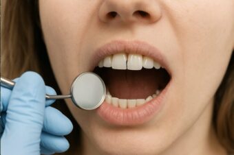 Riss im Zahn wird heute deutlich häufiger erkannt als früher. Frühzeitige Diagnose beim Zahnarzt in Biel/Bienne (Alexander-Schöni-Strasse) schützt vor Zahnverlust.